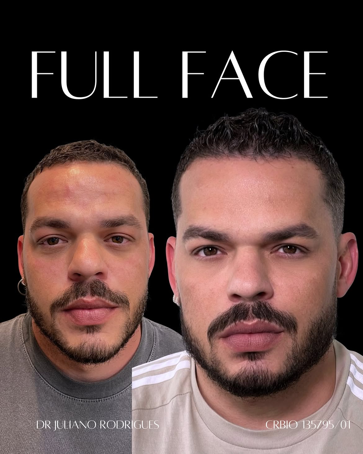 Antes e Depois 3